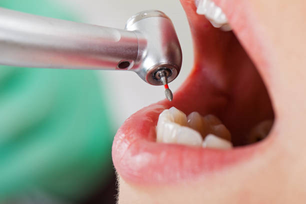Best Emergency Tooth Extraction in Davenport, IA